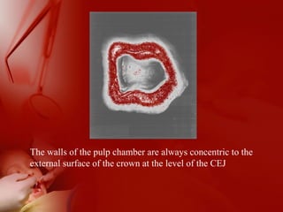 The walls of the pulp chamber are always concentric to the
external surface of the crown at the level of the CEJ
 