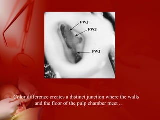 Color difference creates a distinct junction where the walls
and the floor of the pulp chamber meet ..
 