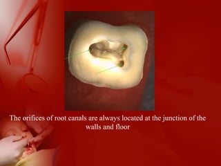 The orifices of root canals are always located at the junction of the
walls and floor
 