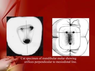 Cut specimen of mandibular molar showing
orifices perpendicular to mesiodistal line.
 