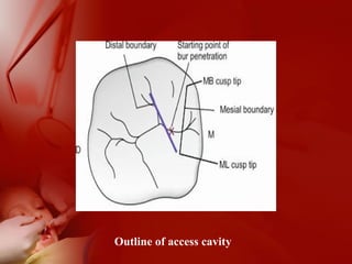 Outline of access cavity
 