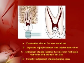A Penetration with no 2 or no 4 round bur
B Exposure of pulp chamber with tapered fissure bur
C Refinement of pulp chamber & removal of roof using
round bur from inside to out side
D Complete refinement of pulp chamber space
A
D
 