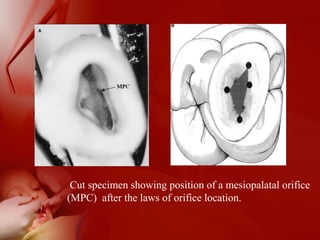 Cut specimen showing position of a mesiopalatal orifice
(MPC) after the laws of orifice location.
 