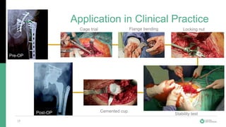 Application in Clinical Practice
17
Pre-OP
Cage trial Flange bending Locking nut
Stability test
Cemented cupPost-OP
 