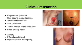 Clinical Presentation
• Large tumor palpable
• Skin edema- peau’d orange
• Satellite skin nodules
• Skin ulceration
• Tumor fixation to the chest wall
• Fixed axillary nodes
• Axillary
• Infra-clavicular and
• supraclavicular adenopathy
 