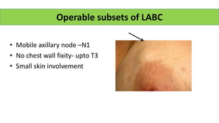 • Mobile axillary node –N1
• No chest wall fixity- upto T3
• Small skin involvement
Operable subsets of LABC
 