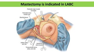 Mastectomy is indicated in LABC
 