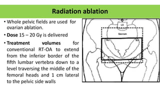 Radiation ablation
• Whole pelvic fields are used for
ovarian ablation.
• Dose 15 – 20 Gy is delivered
• Treatment volumes for
conventional RT-OA to extend
from the inferior border of the
ﬁfth lumbar vertebra down to a
level traversing the middle of the
femoral heads and 1 cm lateral
to the pelvic side walls
 