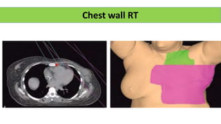 Chest wall RT
 