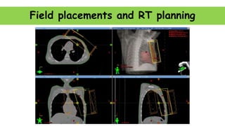 Field placements and RT planning
 
