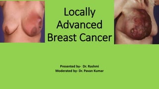 Locally
Advanced
Breast Cancer
Presented by- Dr. Rashmi
Moderated by- Dr. Pavan Kumar
 