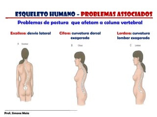 Prof. Simone Maia
Problemas de postura que afetam a coluna vertebral
Escoliose: desvio lateral Cifose: curvatura dorsal
exagerada
Lordose: curvatura
lombar exagerada
esqueleto humano – PROBLEMAS ASSOCIADOS
 