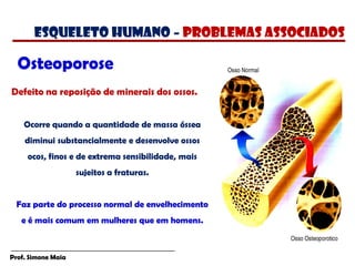 Prof. Simone Maia
Osteoporose
Defeito na reposição de minerais dos ossos.
Ocorre quando a quantidade de massa óssea
diminui substancialmente e desenvolve ossos
ocos, finos e de extrema sensibilidade, mais
sujeitos a fraturas.
Faz parte do processo normal de envelhecimento
e é mais comum em mulheres que em homens.
esqueleto humano – PROBLEMAS ASSOCIADOS
 
