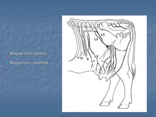 .
 Bloqueo línea incisión
 Bloqueo en L invertida
 
