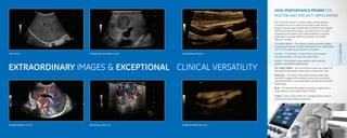 EXTRAORDINARY IMAGES & EXCEPTIONAL CLINICAL VERSATILITY
Liver, C1-5-D
Neonatal cephalic, C3-10-D
Intraoperative liver lesion, L3-9i-D
Breast lesion, ML6-15-D
Carotid plaque, M6-15-D
Carotid stenosis B-Flow, 9L-D
The LOGIQ E9 XDclear 2.0 system offers a wide selection
of probes from our E-Series and XDclear probe lines to
support a broad range of applications. XDclear is GE’s highest
performing probe technology, with advances in acoustic
engineering that deliver ultra-wide bandwidth, increased
penetration, and high deﬁnition resolution. Our probe
selection includes:
C1-6-D/C1-6VN-D – This XDclear workhorse probe enables
outstanding resolution at depth and delivers 4cm+ penetration.
The C1-6VN probe has the sensor in the probe.
C3-10-D – This XDclear convex probe is well-suited for
neonatal, pediatric, and vascular applications.
C2-9-D – This XDclear convex probe is well-suited for
pediatric and OB/GYN applications.
C2-7-D/C2-7VN-D – This microconvex probe has a wide FOV
that reduces blind spots, particularly in intercostal areas.
ML6-15-D – This matrix array linear probe provides high
resolution imaging of ﬁne-detail structures for small parts,
neonatal, pediatric, musculoskeletal, and peripheral vascular
applications.
9L-D – This linear probe supports specialty imaging with a
large footprint and excellent depth of ﬁeld.
L3-9i-D – With its low proﬁle, this T-shaped probe is easy to
maneuver during surgical procedures.
XDCLEARPROBES
HIGH-PERFORMANCE PROBES FOR
ROUTINE AND SPECIALTY APPLICATIONS
 