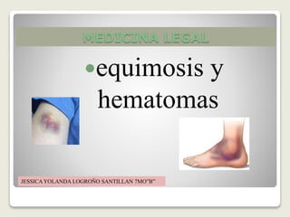 MEDICINA LEGAL
equimosis y
hematomas
JESSICAYOLANDA LOGROÑO SANTILLAN 7MO”B”
 