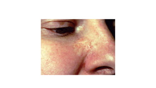 NON MELANOMA AND MELANOMA SKIN MALIGNANCIES NMSC HN REGION | PPTX