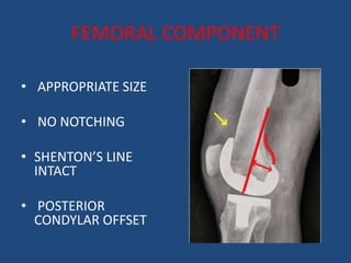 Stenton Line How to Interpret Postoperative X- ray after Total knee arthroplasty.pptx