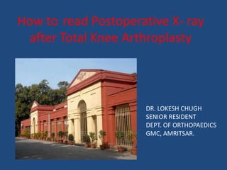 How to read Postoperative X- ray
after Total Knee Arthroplasty
DR. LOKESH CHUGH
SENIOR RESIDENT
DEPT. OF ORTHOPAEDICS
GMC, AMRITSAR.
 