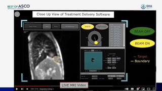 AI & Recent Advances in Radiation Oncology 2024 | PPT