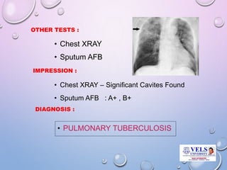 OTHER TESTS :
• Chest XRAY
• Sputum AFB
IMPRESSION :
• Chest XRAY – Significant Cavites Found
• Sputum AFB : A+ , B+
DIAGNOSIS :
• PULMONARY TUBERCULOSIS
 
