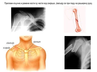 Преломи кључне и рамене кости су чести код скијаша. Јављају се при паду на раширену руку.
clavicula
scapula
sternum
 