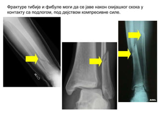 Фрактуре тибије и фибуле моги да се јаве након скијашког скока у
контакту са подлогом, под дејством компресивне силе.
 