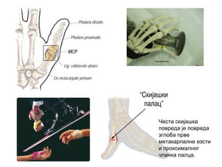“Скијашки
палац”
Phalanx distalis
Phalanx proximalis
MCP
Lig. collaterale ulnare
Os metacarpale primum
Честа скијашка
повреда је повреда
зглоба прве
метакарпалне кости
и проксималног
чланка палца.
 