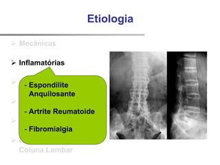 Etiologia
 Mecânicas
 Inflamatórias
 Infecciosas
 Metabólicas
 Tumorais
 Dor Visceral Referida
Coluna Lombar
- Espondilite
Anquilosante
- Artrite Reumatoide
- Fibromialgia
 