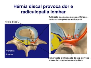 Vértebra
lombar
Hérnia discal provoca dor e
radiculopatia lombar
Hérnia discal
Activação dos nociceptores periféricos –
causa da componente nociceptiva da dor
Compressão e inflamação da raíz nervosa –
causa da componente neuropática da dor
 