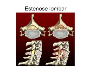 Estenose lombar
 