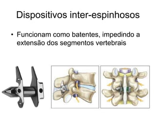 Dispositivos inter-espinhosos
• Funcionam como batentes, impedindo a
extensão dos segmentos vertebrais
 