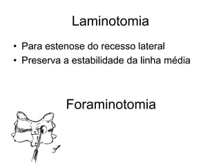Laminotomia
• Para estenose do recesso lateral
• Preserva a estabilidade da linha média
Foraminotomia
 