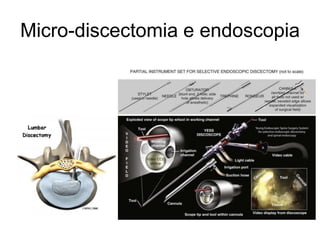 Micro-discectomia e endoscopia
 