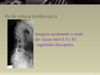 Rx de coluna lombo-sacra
Imagem mostrando o sinal
do vácuo entre L5 e S1
sugerindo discopatia
 