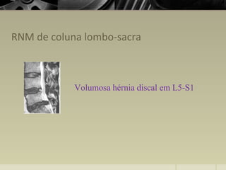 RNM de coluna lombo-sacra
Volumosa hérnia discal em L5-S1
 