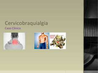 Cervicobraquialgia
Caso Clínico
 