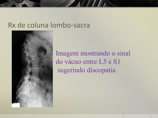 Rx de coluna lombo-sacra
Imagem mostrando o sinal
do vácuo entre L5 e S1
sugerindo discopatia
 