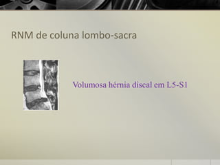RNM de coluna lombo-sacra
Volumosa hérnia discal em L5-S1
 