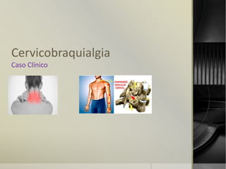 Cervicobraquialgia
Caso Clínico
 