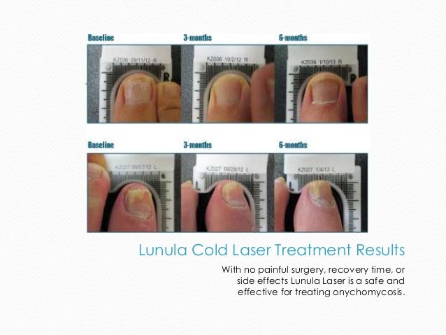 Lunula Laser To Treat Fungal Nail Infection Egham Podiatry