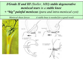 I/Grade II and III (Stoller, MRI) stable degenerative
meniscal tears in a stable knee
+ “big” painful meniscus (para and intra-meniscal cyst)
Meniscal shear forces A stable knee is needed for a good result
 