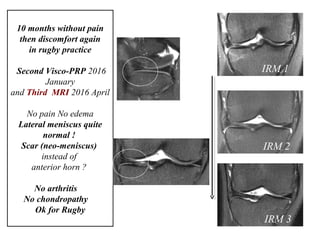 10 months without pain
then discomfort again
in rugby practice
Second Visco-PRP 2016
January
and Third MRI 2016 April
No pain No edema
Lateral meniscus quite
normal !
Scar (neo-meniscus)
instead of
anterior horn ?
No arthritis
No chondropathy
Ok for Rugby
IRM 1
IRM 2
IRM 3
 