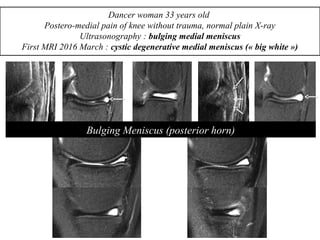 Bulging Meniscus (posterior horn)
Dancer woman 33 years old
Postero-medial pain of knee without trauma, normal plain X-ray
Ultrasonography : bulging medial meniscus
First MRI 2016 March : cystic degenerative medial meniscus (« big white »)
 