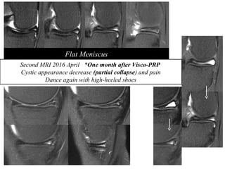Flat Meniscus
Second MRI 2016 April *One month after Visco-PRP
Cystic appearance decrease (partial collapse) and pain
Dance again with high-heeled shoes
 