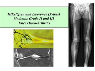 II/Kellgren and Lawrence (X-Ray)
Moderate Grade II and III
Knee Osteo-Arthritis
 