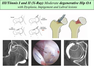 III/Tönnis I and II (X-Ray) Moderate degenerative Hip OA
with Dysplasia, Impigement and Labral lesions
 