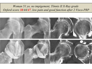 Woman 51 yo, no impigement, Tönnis II X-Ray grade
Oxford score 38/44/47, low pain and good function after 2 Visco-PRP
 