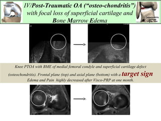 IV/Post-Traumatic OA (“osteo-chondritis”)
with focal loss of superficial cartilage and
Bone Marrow Edema
Knee PTOA with BME of medial femoral condyle and superficial cartilage defect
(osteochondritis). Frontal plane (top) and axial plane (bottom) with a target sign
Edema and Pain highly decreased after Visco-PRP at one month.
 