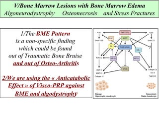 1/The BME Pattern
is a non-specific finding
which could be found
out of Traumatic Bone Bruise
and out of Osteo-Arthritis
2/We are using the « Anticatabolic
Effect » of Visco-PRP against
BME and algodystrophy
V/Bone Marrow Lesions with Bone Marrow Edema
Algoneurodystrophy Osteonecrosis and Stress Fractures
 